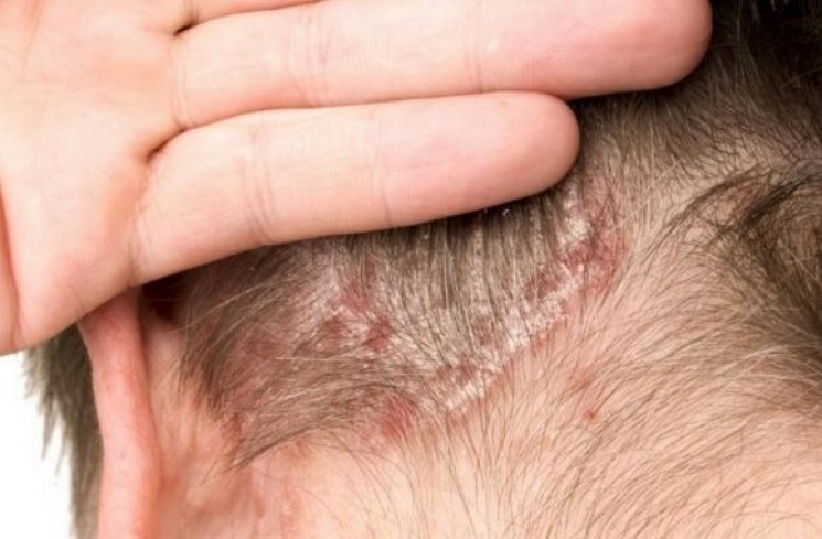 Psoriasis. (shutterstock)