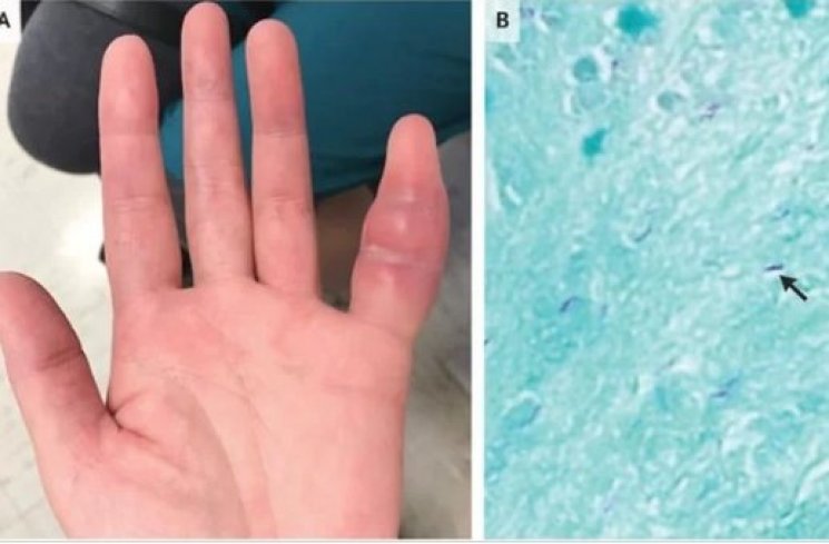Jari kelingking terinfeksi bakteri tuberkulosis. (livescience)