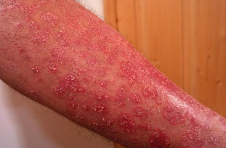 Contoh psoriasis. (pixabay/hans)
